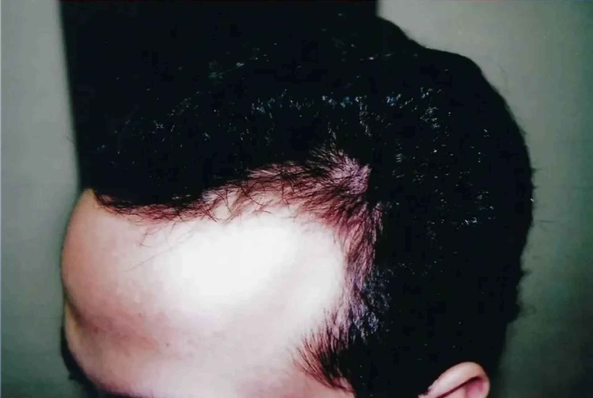 After treatment 3