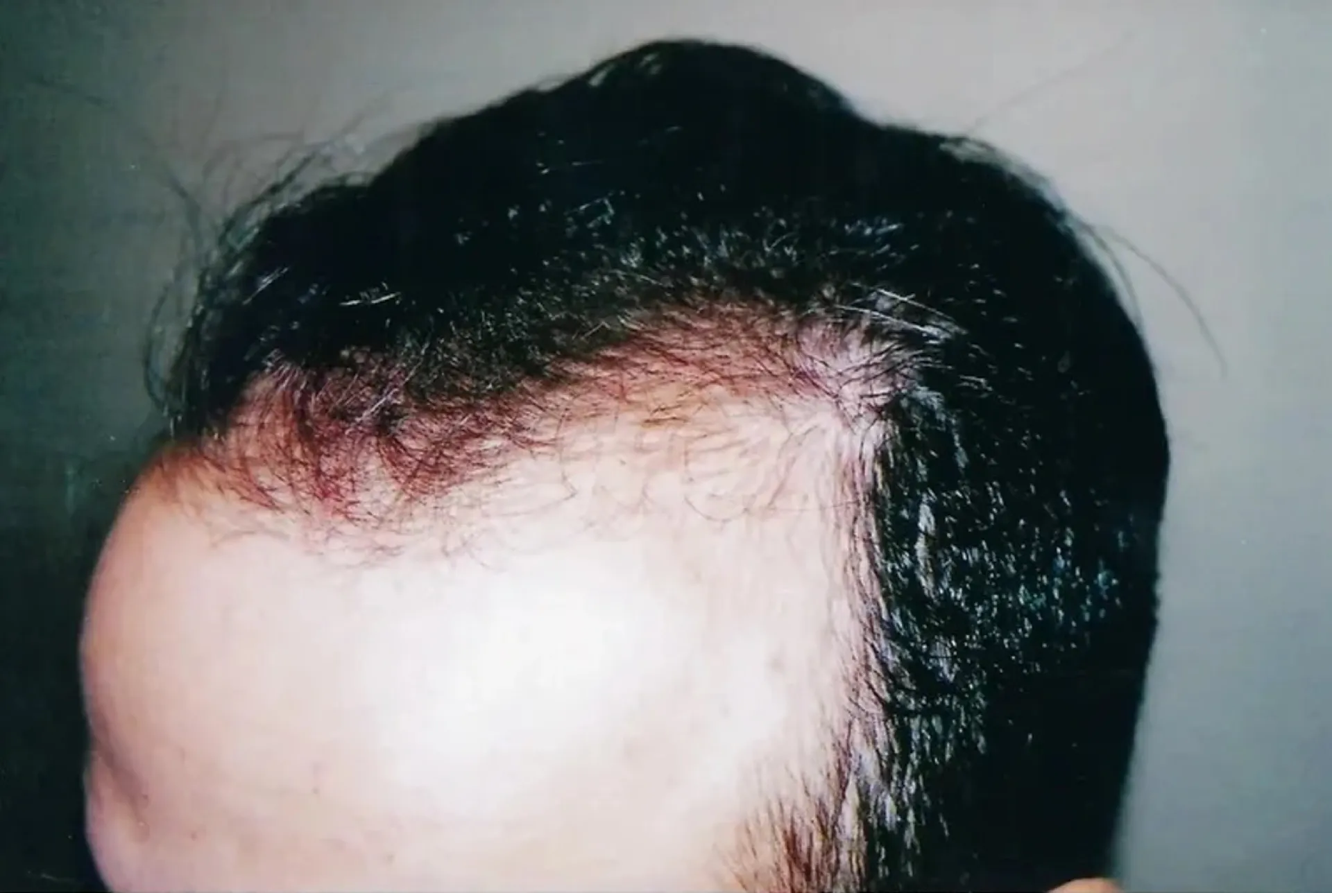 Before treatment 3