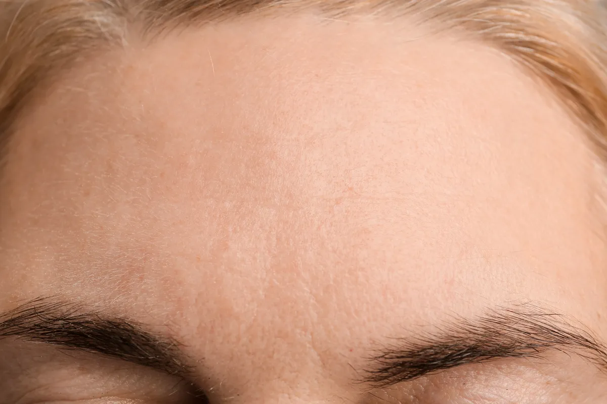 After treatment 3