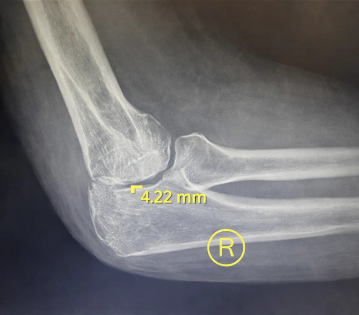 After treatment 4