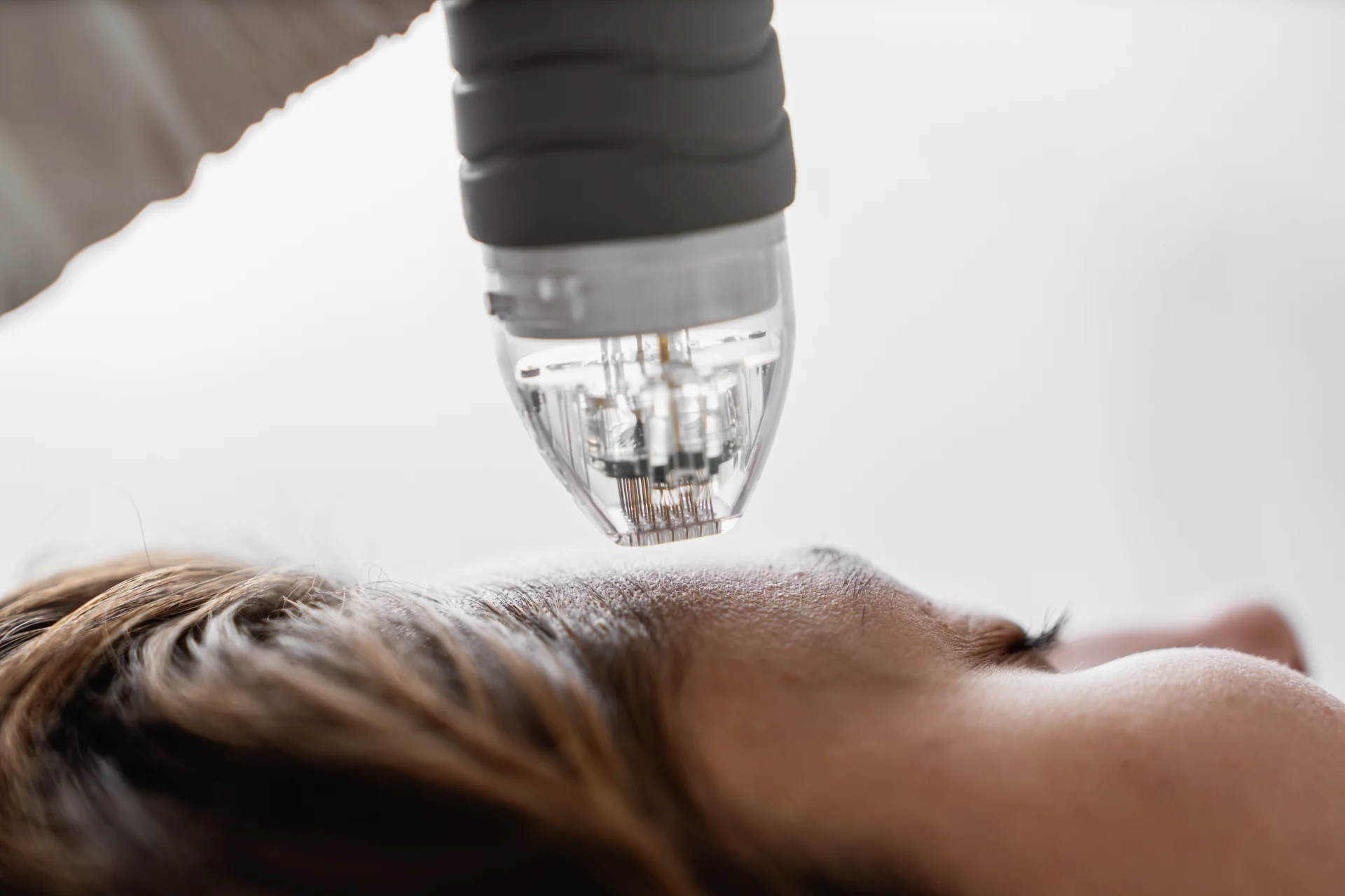 Microneedling treatment session