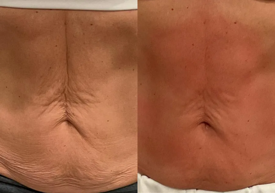 Non-surgical body contouring and cellulite reduction treatment at Regen & Restore