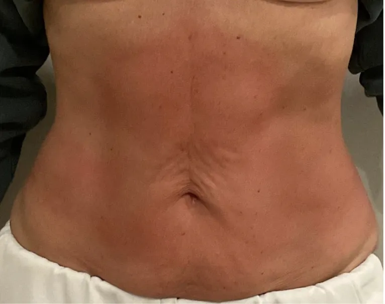 After treatment 2