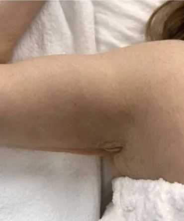 After treatment 3