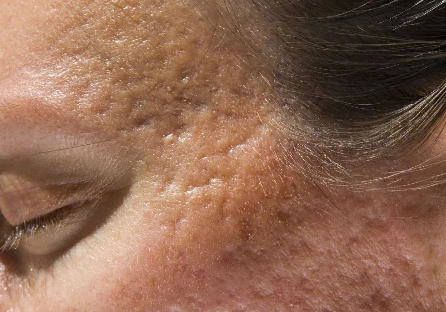 Provider evaluating acne scarring before a collagen-rebuilding skin treatment
