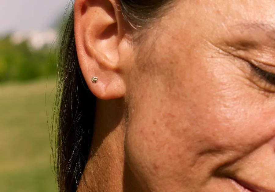 Close-up of skin with sun spots and photoaging being evaluated for UV damage repair at a medical aesthetics clinic